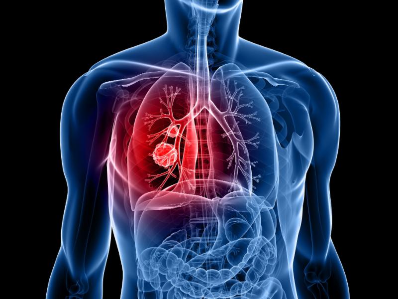Lung cancer_diagram